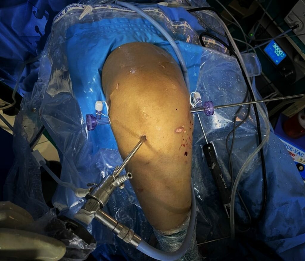 ACL Reconstruction Image