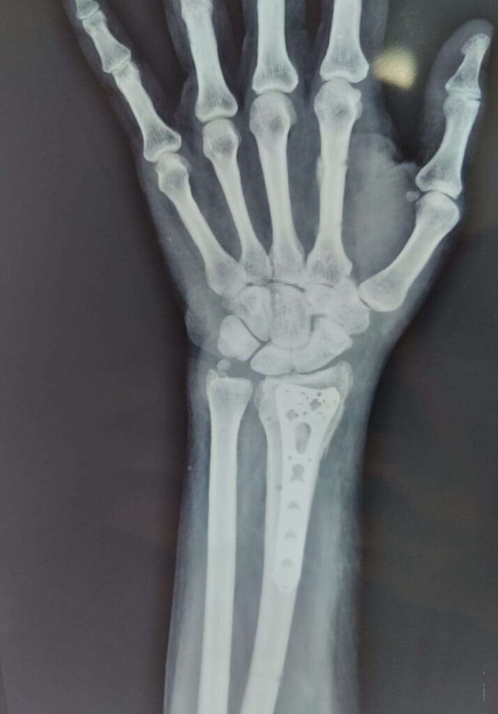 wrist fracture x-ray