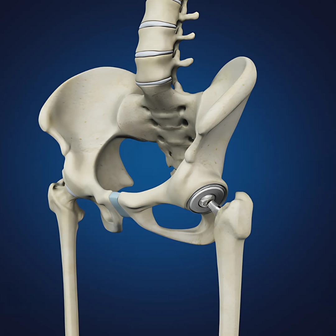 Hip Fractures and Prevention