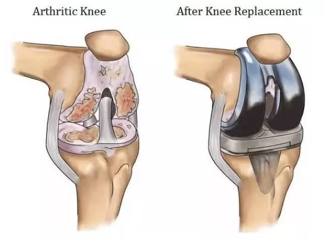 arthritis and Knee Replacement