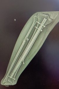 Rotator cuff repair in HSR layout, BTM, koramangala