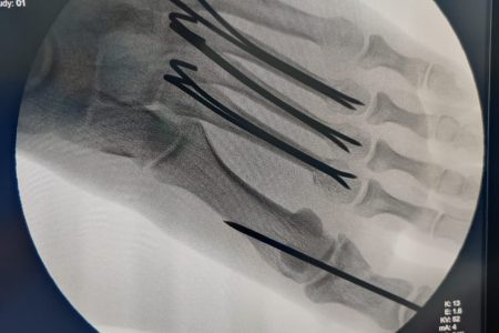 Rotator cuff repair in HSR layout, BTM, koramangala | dr Akshay shetty